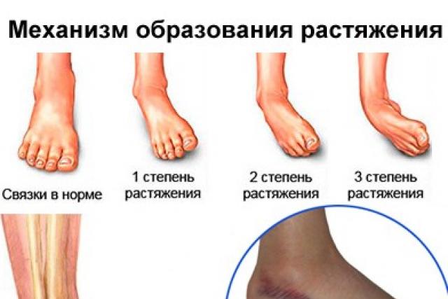 Растяжение связок: как грамотно помочь пострадавшему Боль при растяжении